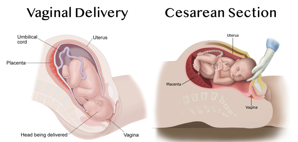  Vaginal delivery and cesarean section impacts the type of microbes that seed baby's gut microbiome.